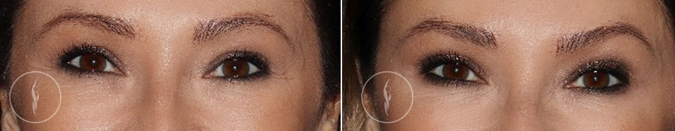 Botox Injections Before and After