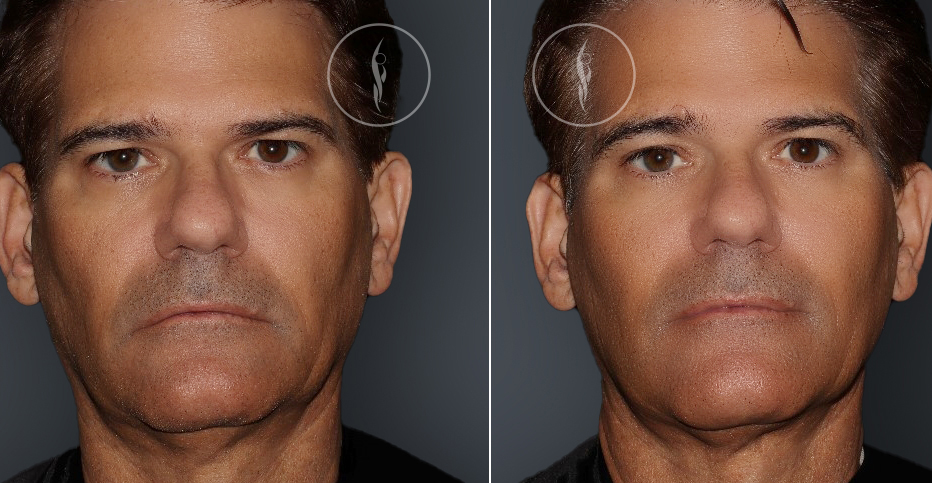 Ultherapy Non Surgical Facelift Results