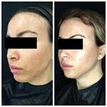 HALO Treatment Results