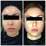 HALO Treatment Results
