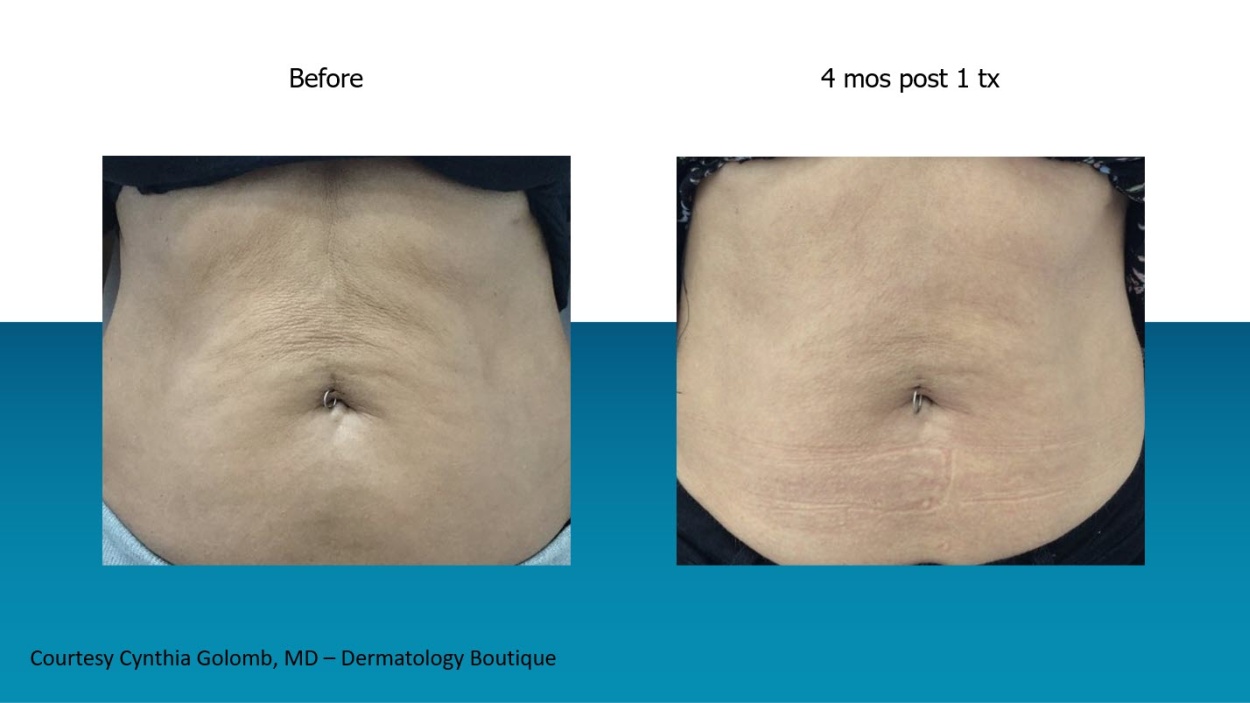Genius RF Microneedling Before & After %city% %state%