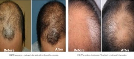 PRP Hair Restoration Results