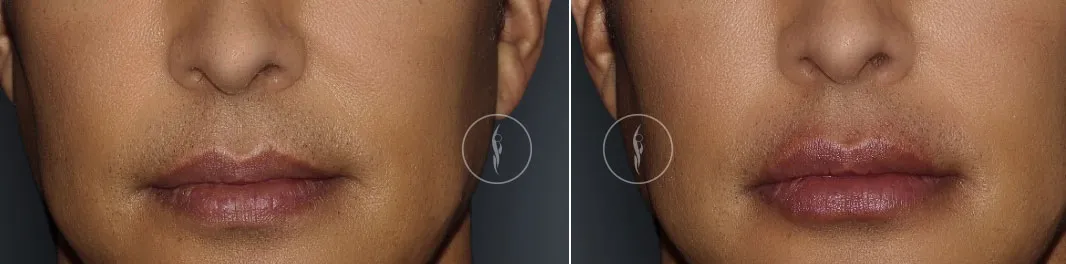 Juvederm Fort Lauderdale