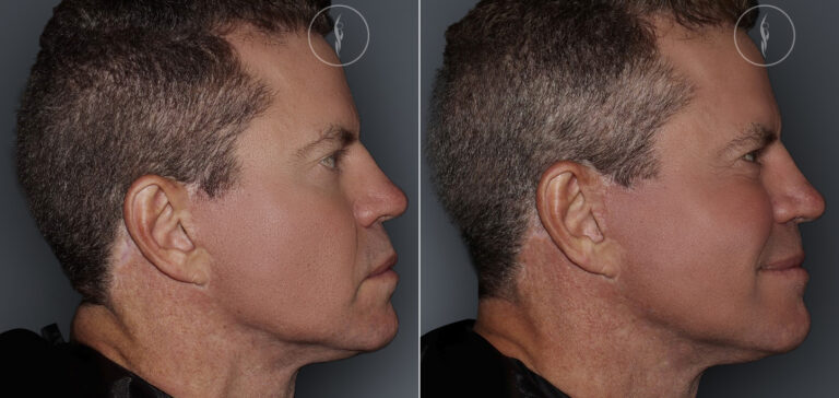 Sculptra Before and After