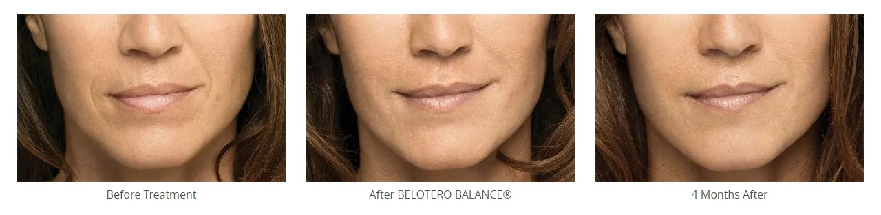 Belotero Before and After