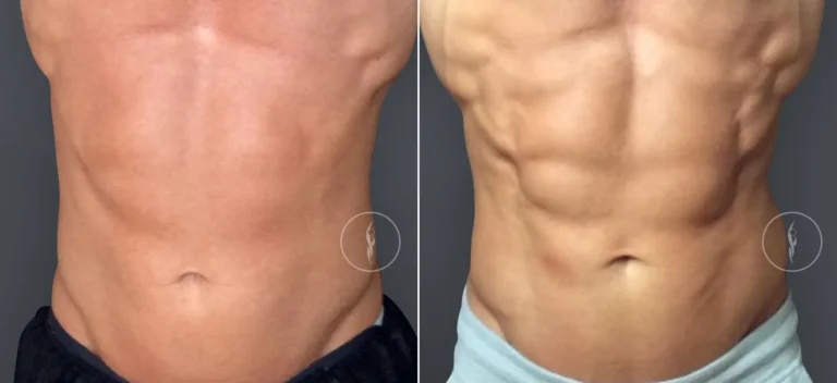 Accufit Muscle Toning Before and After