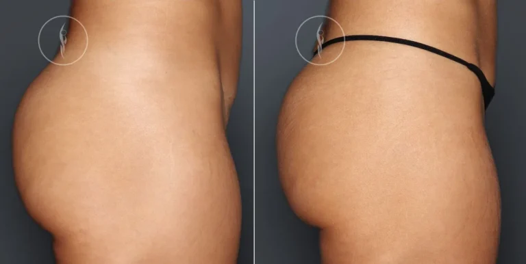 Genesis Booty Enhancement Before and After