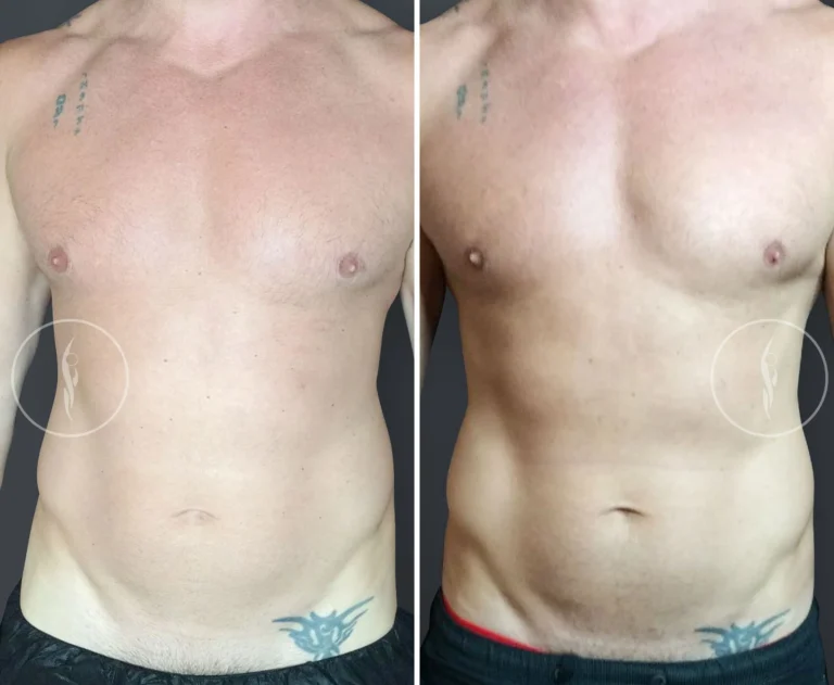 SculpSure Body Contouring Before and After
