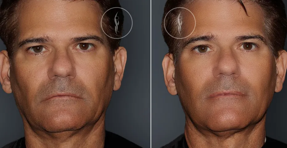 Ultherapy Before and After