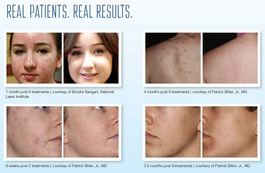 Forever Clear BBL Acne Treatment Results